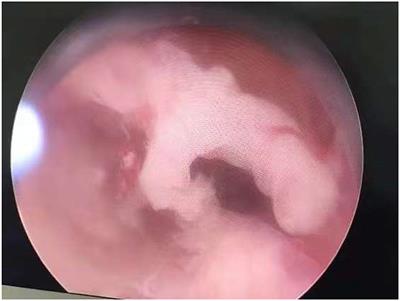 Hysteroscopic hysteroplasty for the treatment of T-shaped uteri in women with reproductive failure